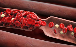 6 dấu hiệu cảnh báo có cục máu đông trong cơ thể mà bạn không được phép bỏ qua