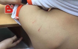 Hà Nội: Xôn xao việc giáo viên mầm non đánh con riêng của chồng thâm tím cơ thể