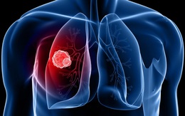 Nếu ho mà có kèm những triệu chứng sau, cần nghĩ đến ung thư phổi