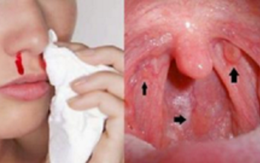 Ung thư vòm họng - 1 bệnh ung thư đứng đầu ở VN: 3 dấu hiệu phát hiện bệnh sớm cần nhớ