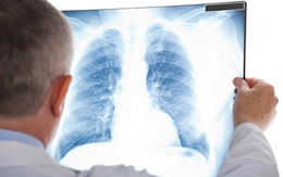 "Chụp X-quang nhiều mai mốt ung thư chết luôn": Đâu là sự thật?