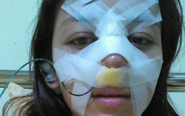 Cô gái chịu đau đớn 'chết đi sống lại' khi nâng mũi để sửa tướng