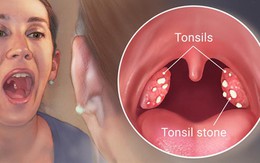 Bệnh ung thư khiến nam giới tử vong cao gấp 10 lần phụ nữ: 9 dấu hiệu có thể thấy ở miệng
