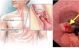 Phó giáo sư Nhật: 4 thói quen gây nguy cơ ung thư thực quản, ai mắc cần chú ý kiểm tra