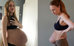 Bà mẹ sinh ba có bụng bầu dài bất thường lại gây sốt với vòng hai như chưa đẻ sau khi sinh 1 tháng
