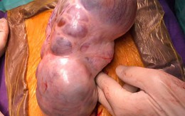 Cắt khối u dài 20cm như "bào thai em bé" cho bệnh nhân ung thư buồng trứng