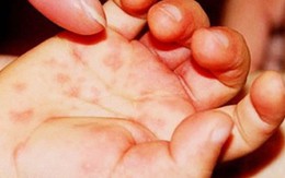 Chủng virus gây đại dịch tay chân miệng năm 2011 đã trở lại?