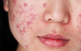 “Cơn bão” làm đẹp tàn phá nhan sắc