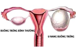 U nang buồng trứng – Chị em chớ chủ quan!