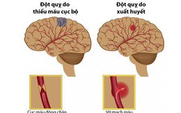 Nhiệt độ miền Bắc giảm sâu: Bác sĩ cảnh báo thời điểm "đen" hay xảy ra đột quỵ