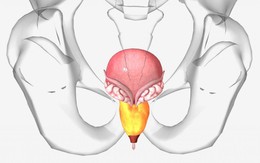 Bác sĩ cảnh báo sớm 5 triệu chứng viêm tuyến tiền liệt: Nếu ai thấy giống là phải đi khám