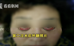 Ham mê phẫu thuật thẩm mỹ, người phụ nữ 60 tuổi không thể nhắm được mắt khi ngủ và có nguy cơ bị mù