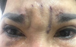 Treo chỉ làm đẹp, bị biến dạng luôn đôi mắt