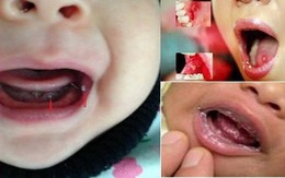 Phát hiện nốt nhỏ ở miệng hãy coi chừng trẻ đang mắc loại nấm nguy hiểm