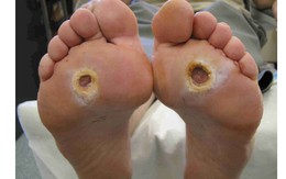Tê chân: Coi chừng là biến chứng sớm của căn bệnh có thể khiến bạn phải cắt cụt chân
