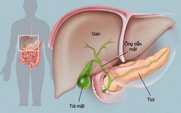 Quá nhiều dầu mỡ, chất đạm, rượu bia, cấp cứu vì viêm tụy cấp