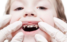 5 quan niệm sai lầm khiến trẻ bị hỏng răng ngay từ nhỏ, các bậc cha mẹ cần chú ý