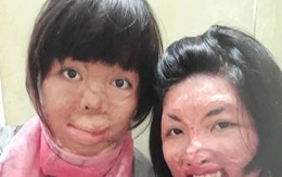 2 người phụ nữ bị chồng tẩm xăng đốt “nắm tay” nhau tô hồng cuộc sống