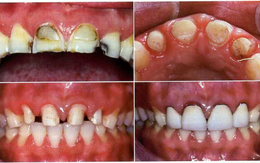 Bác sĩ BV Răng hàm mặt Trung ương chỉ rõ 3 biến chứng đáng sợ của răng sứ thẩm mỹ