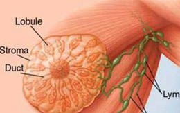 Bác sĩ BV K khuyến cáo: Phát hiện trên ngực có "khối u" này, chị em nên bình tĩnh xử trí