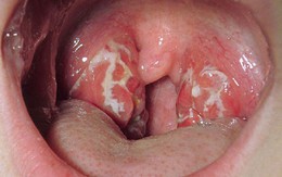 Đây là những đối tượng mà ung thư vòm họng dễ “nhắm” tới nhất