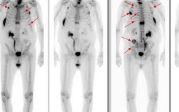 Ung thư di căn xương: Những điều cần biết