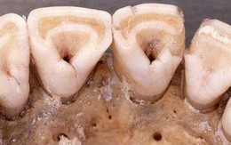 Răng sữa hình xẻng - điểm tiến hóa này chỉ có ở người Đông Á và thổ dân châu Mỹ, nhưng bất ngờ nhất là...