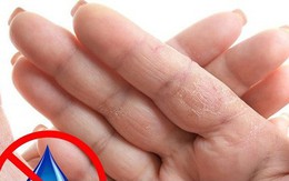 Dấu hiệu bàn tay cho thấy các vấn đề về sức khỏe của bạn