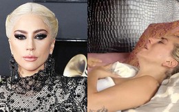 Lady Gaga: Bệnh tật đau đớn ở tuổi 32 và nỗi ám ảnh bị cưỡng hiếp