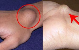 Xuất hiện cục u nổi bất thường ở cổ tay: Đừng bỏ qua vì đó có thể là dấu hiệu cảnh báo bệnh nguy hiểm