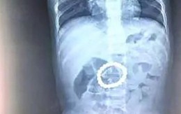 Hình ảnh chụp X-quang dạ dày của bé trai 14 tháng tuổi và lời cảnh tỉnh các bố mẹ về món đồ chơi mà trẻ nhỏ rất thích