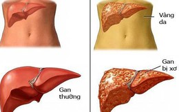 Bệnh lý về gan ở VN có xu hướng gia tăng: Đừng coi thường biểu hiện tổn thương gan sớm