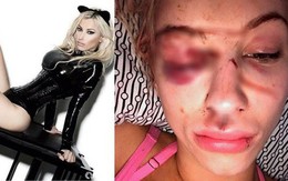 Bị bạn trai giam giữ và hành hung đến mù một mắt, người mẫu trẻ gửi ảnh selfie kêu cứu và được giải thoát thành công