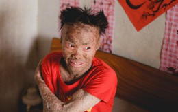 Chàng trai "người cá" lạc quan ở Hà Nội: Nhìn thấy bộ dạng của mình, nhiều người hỏi sao không chết đi, sống để làm gì?