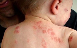 6 bệnh ngoài da hay gặp ở trẻ mùa nắng nóng