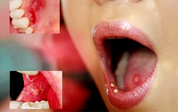 Đề cao cảnh giác với ung thư và bệnh tim nếu răng miệng xuất hiện những dấu hiệu này