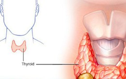 Nổi hạch to ở cổ - Dấu hiệu cảnh báo ung thư tuyến giáp