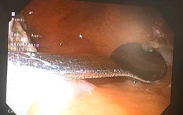 Nghệ An: Thiếu nữ 20 tuổi uống cafe nuốt cả thìa vào bụng