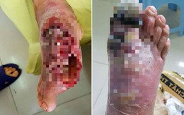 Hà Nội: Bác sĩ phải cắt lọc thịt bàn chân hoại tử cứu sống bệnh nhân tự ý chữa tiểu đường
