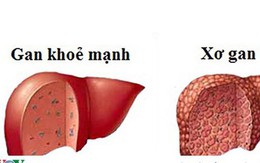 Bỏ túi danh sách thực phẩm ngăn ngừa xơ gan tốt nhất