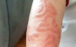 Hai đứa trẻ đau đớn khi tay, lưng sưng tấy do vẽ henna trong chuyến du lịch và lời cảnh báo nhiều phụ huynh bỏ qua