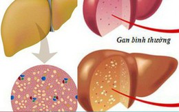 Top 4 nguyên nhân gây gan nhiễm mỡ và cách phòng tránh