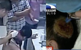 Trung Quốc: Đặt pin dự phòng dưới gối khi ngủ, pin bất ngờ phát nổ khiến người đàn ông bị cháy đen thui một mảng đầu