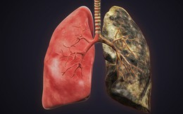 6 nhóm người có nguy cơ cao mắc ung thư phổi: 5 giải pháp phòng ngừa sớm giúp giảm tử vong
