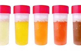 Xem màu nước tiểu để biết tình trạng sức khỏe của bạn: Cách đơn giản để phát hiện bệnh sớm