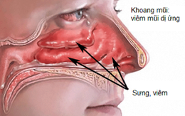 Viêm mũi dị ứng dễ nhầm với viêm xoang: Chuyên gia tai mũi họng chỉ cách phân biệt