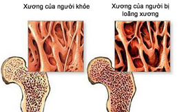 Bác sĩ xương khớp cảnh báo: Nhiều người Việt mắc chứng bệnh này xương chẳng khác gì gỗ mục