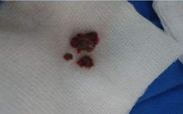 Mẩu xương heo nằm trong phổi nam bệnh nhân suốt một năm