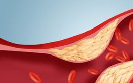 Cảnh báo 6 bệnh lý dễ gặp phải nếu cholesterol tăng cao