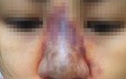 Nâng mũi làm đẹp, người phụ nữ có nguy cơ mù mắt